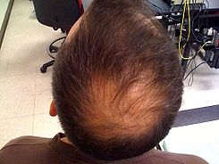 Alopecia Comun