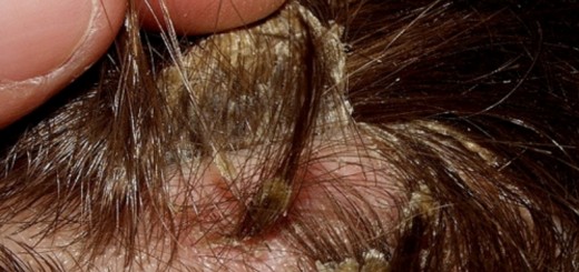 Alopecia por dermatitis