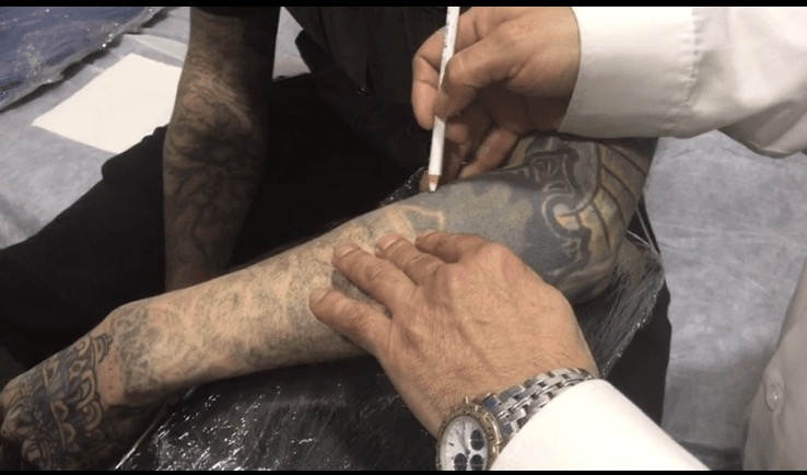 Curso eliminacion laser de tatuajes